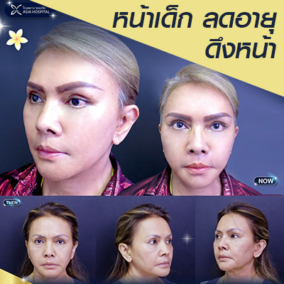 ผ่าตัดดึงหน้า-facelift